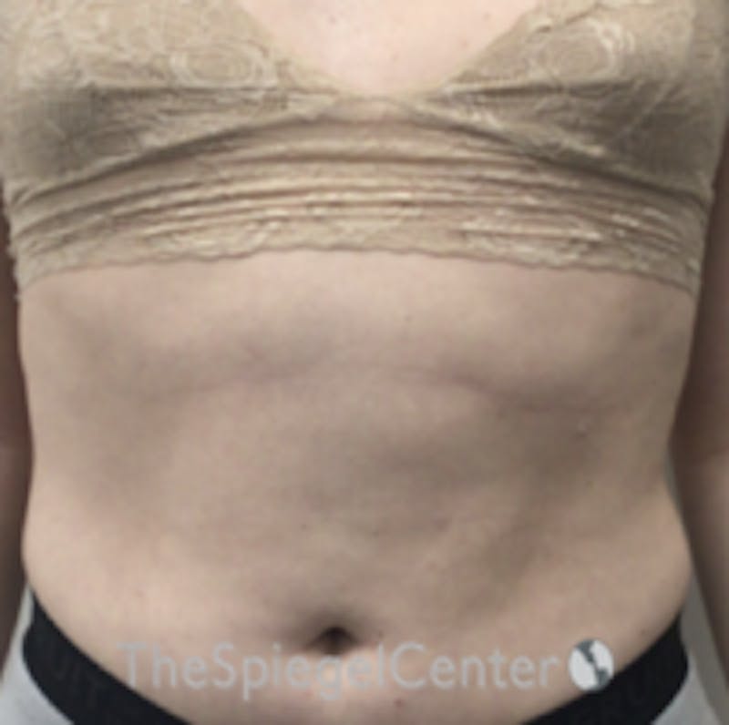 Liposuction Before & After Gallery - Patient 157140663 - Image 1