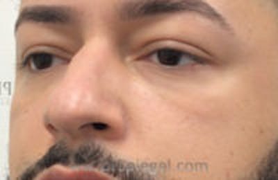 Tear Trough / Under Eye Fillers Before & After Gallery - Patient 157140650 - Image 4