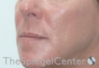 Nasolabial Fold Filler Before & After Gallery - Patient 157140653 - Image 4