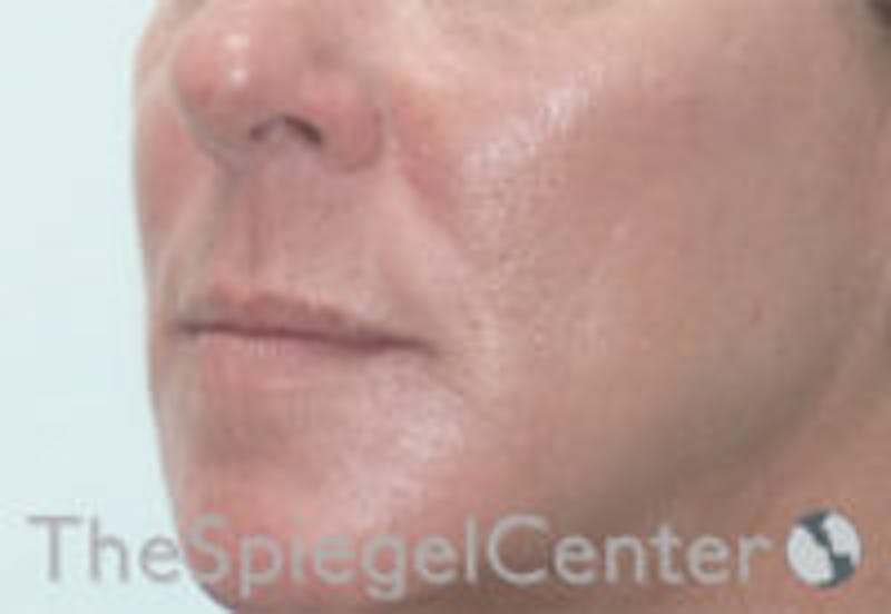 Nasolabial Fold Filler Before & After Gallery - Patient 157140653 - Image 4