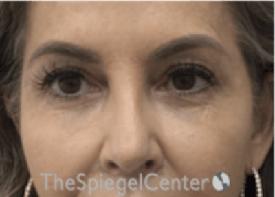 Temple Filler Before & After Gallery - Patient 157140651 - Image 2
