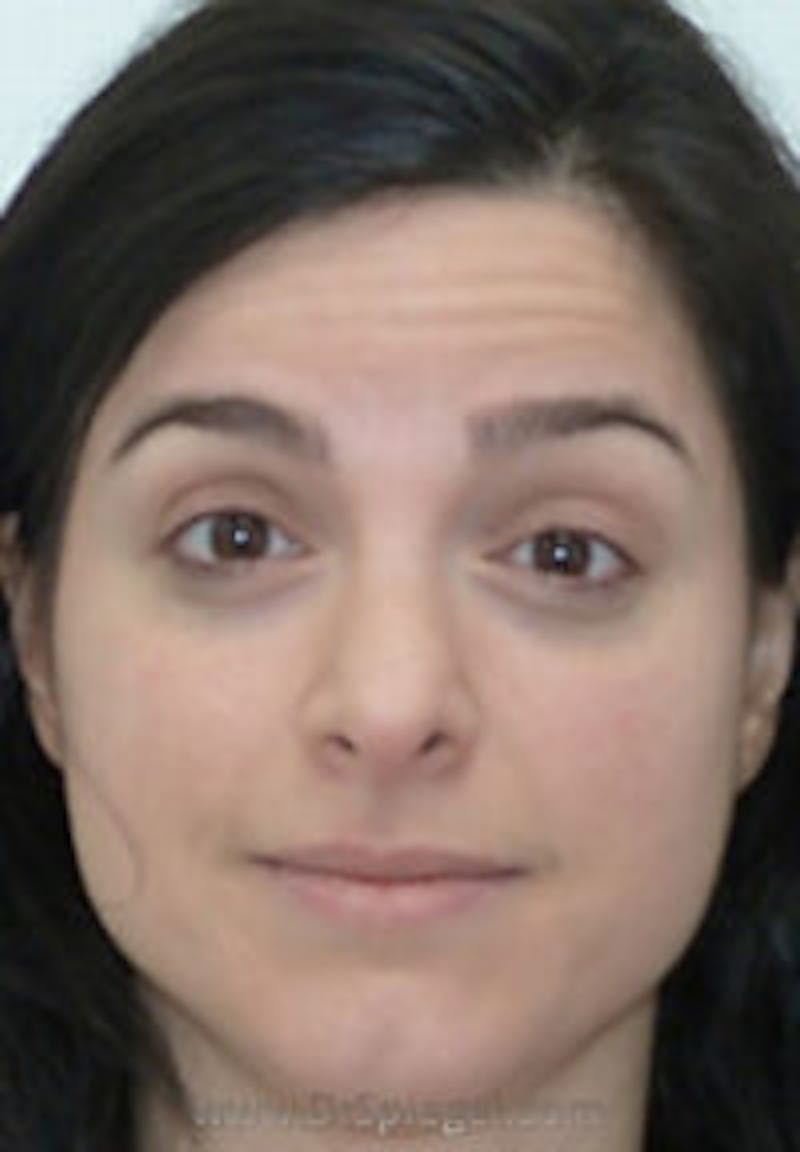 Botox / Dysport / Jeuveau / Xeomin Before & After Gallery - Patient 157140655 - Image 1