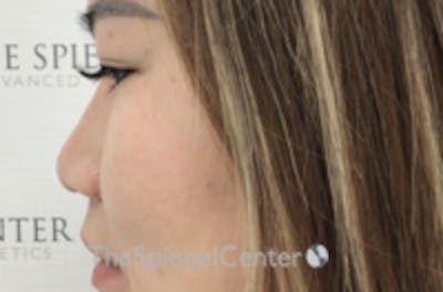 Non-Surgical Rhinoplasty / Nose Filler Before & After Gallery - Patient 157140656 - Image 4
