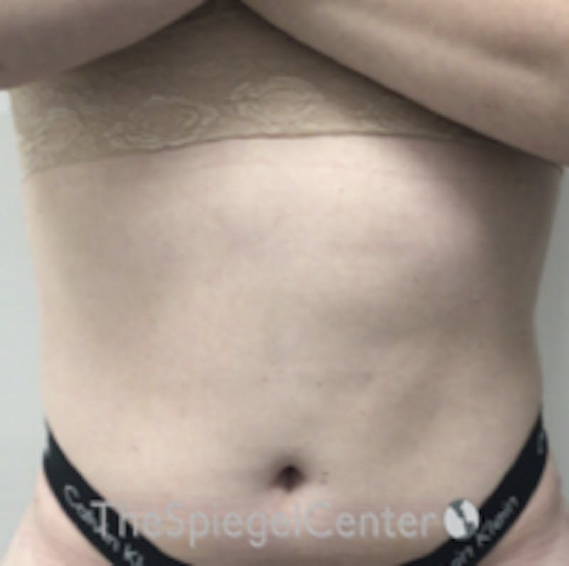 Liposuction Before & After Gallery - Patient 157140663 - Image 2