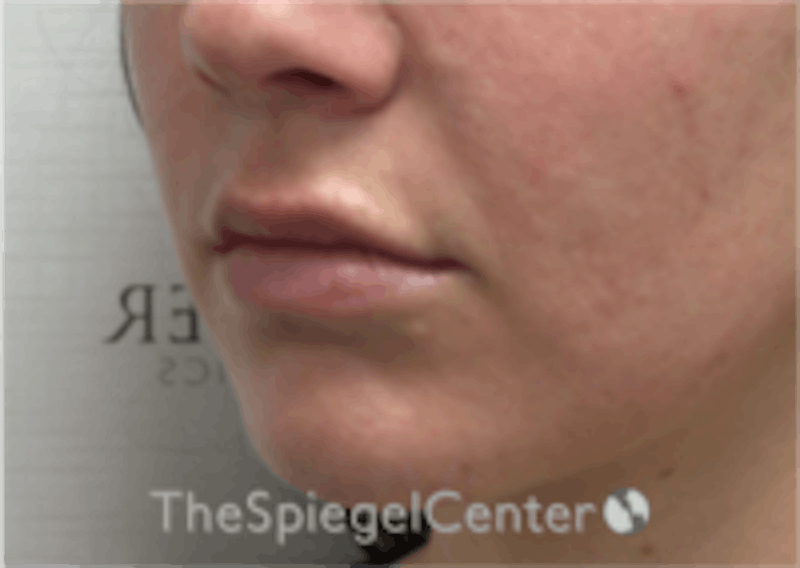 Lip Filler Before & After Gallery - Patient 157140658 - Image 5