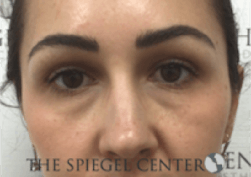 Tear Trough / Under Eye Fillers Before & After Gallery - Patient 157140669 - Image 1