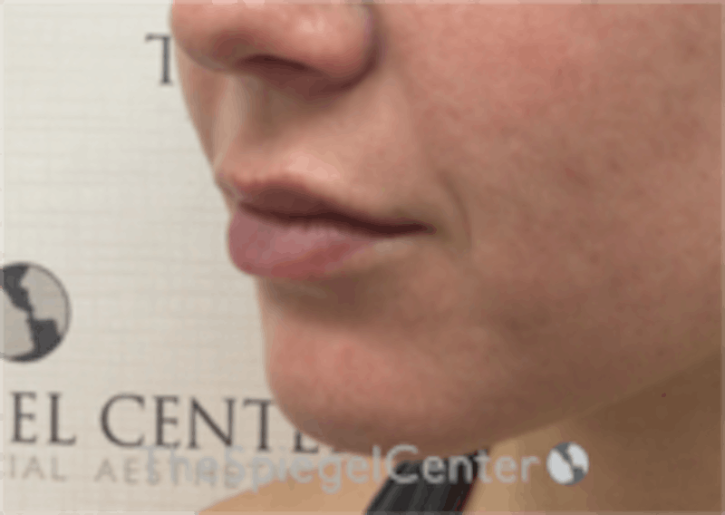 Lip Filler Before & After Gallery - Patient 157140658 - Image 6