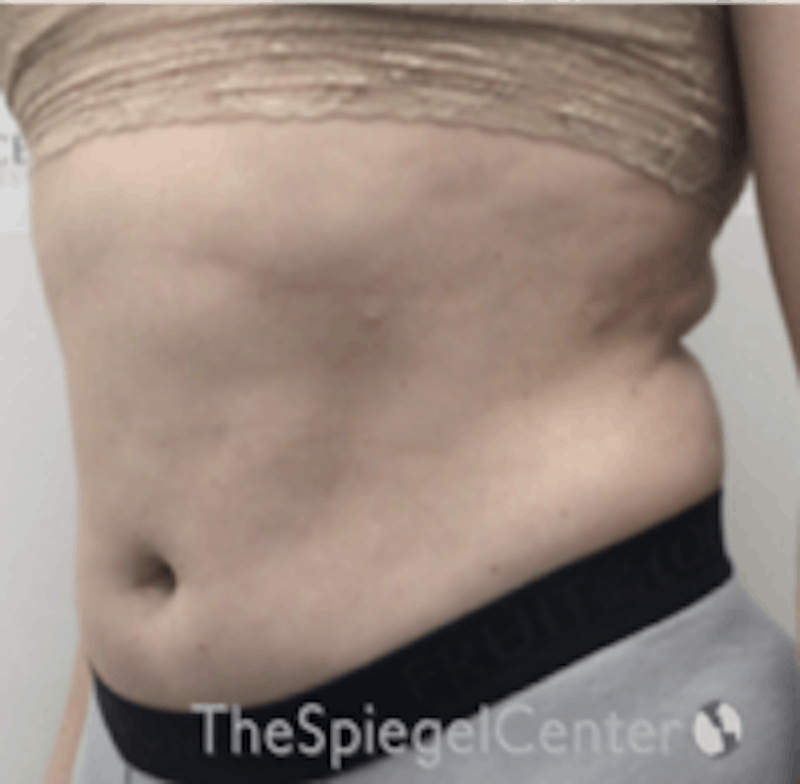 Liposuction Before & After Gallery - Patient 157140663 - Image 3