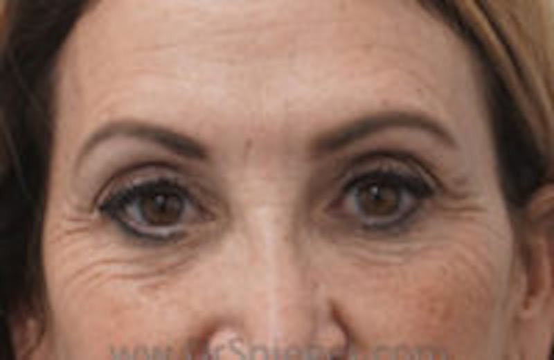 Temple Filler Before & After Gallery - Patient 157140662 - Image 1