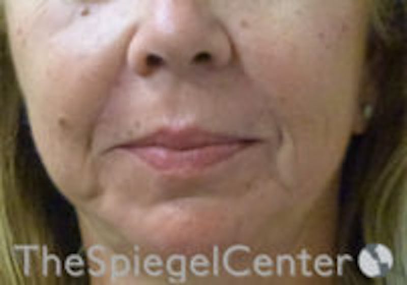Nasolabial Fold Filler Before & After Gallery - Patient 157140665 - Image 1