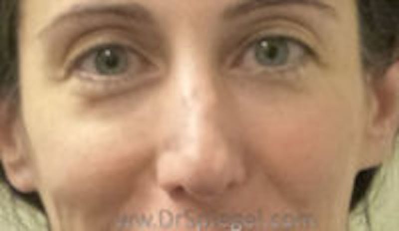 Rhinoplasty Before & After Gallery - Patient 157140661 - Image 1