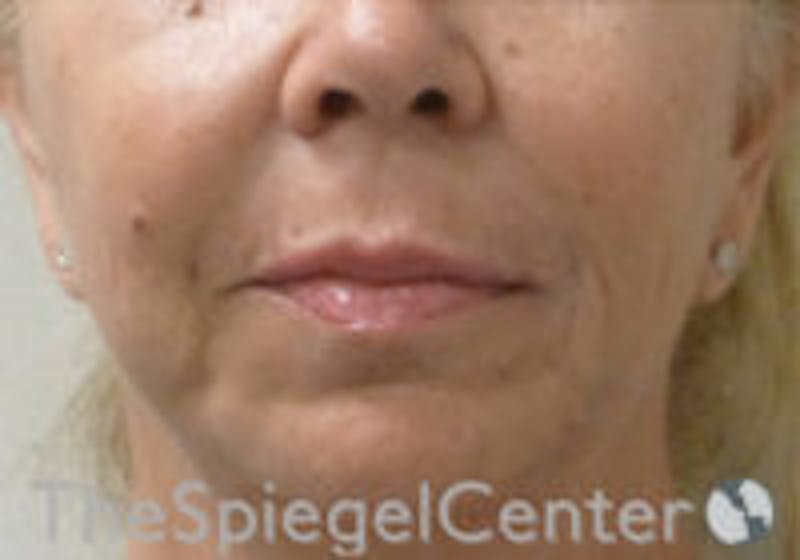 Nasolabial Fold Filler Before & After Gallery - Patient 157140665 - Image 2