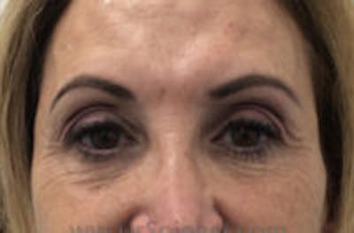 Temple Filler Before & After Gallery - Patient 157140662 - Image 2