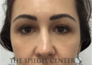 Tear Trough / Under Eye Fillers Before & After Gallery - Patient 157140669 - Image 2