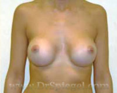 Breast Augmentation Before & After Gallery - Patient 157140660 - Image 2