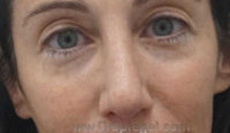 Rhinoplasty Before & After Gallery - Patient 157140661 - Image 2