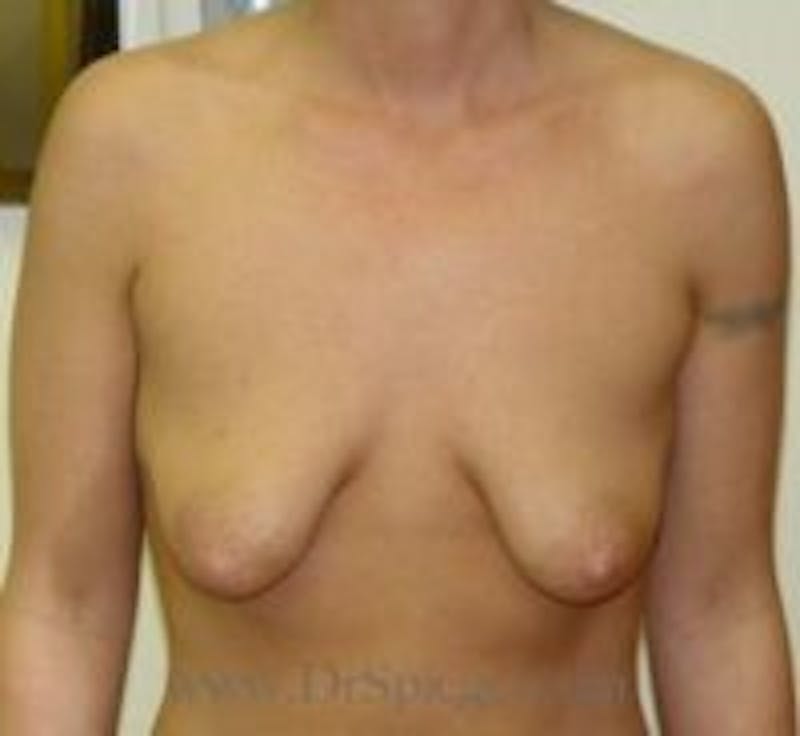 Breast Lift Before & After Gallery - Patient 157140664 - Image 1