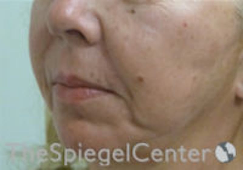 Nasolabial Fold Filler Before & After Gallery - Patient 157140665 - Image 3