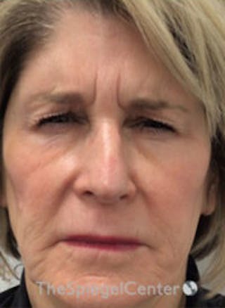 Botox / Dysport / Jeuveau / Xeomin Before & After Gallery - Patient 157140670 - Image 2
