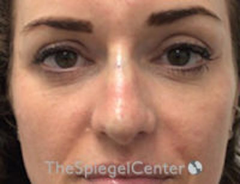Non-Surgical Rhinoplasty / Nose Filler Before & After Gallery - Patient 157140672 - Image 2