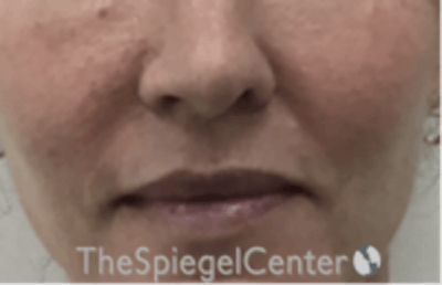 Lip Lift Before & After Gallery - Patient 261335 - Image 1