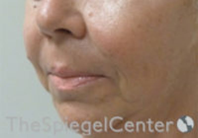 Nasolabial Fold Filler Before & After Gallery - Patient 157140665 - Image 4