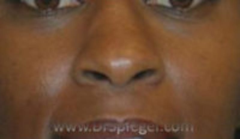Rhinoplasty Before & After Gallery - Patient 157140671 - Image 1