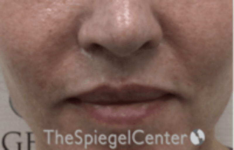 Lip Lift Before & After Gallery - Patient 261335 - Image 2