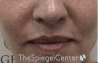 Lip Lift Before & After Gallery - Patient 261335 - Image 2