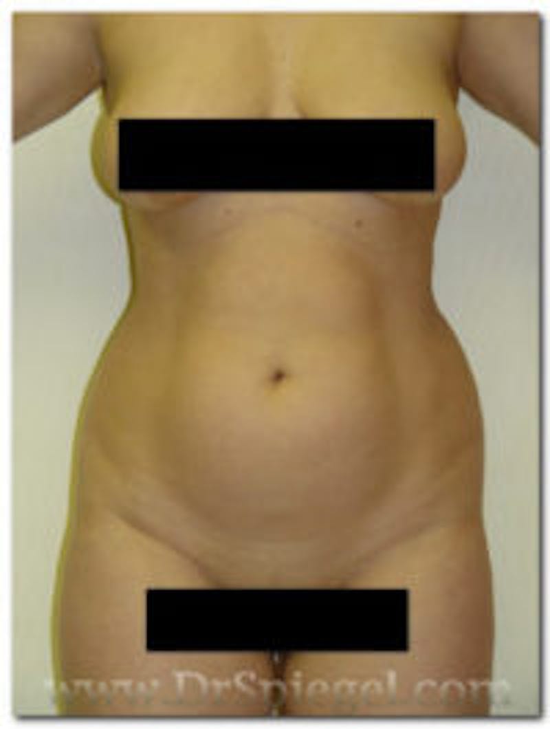 Liposuction Before & After Gallery - Patient 157140673 - Image 1