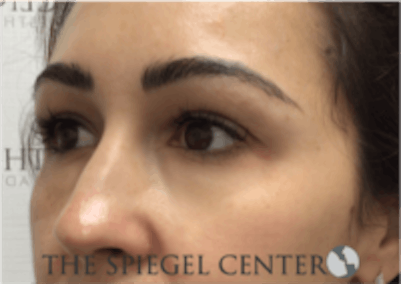 Tear Trough / Under Eye Fillers Before & After Gallery - Patient 157140669 - Image 4