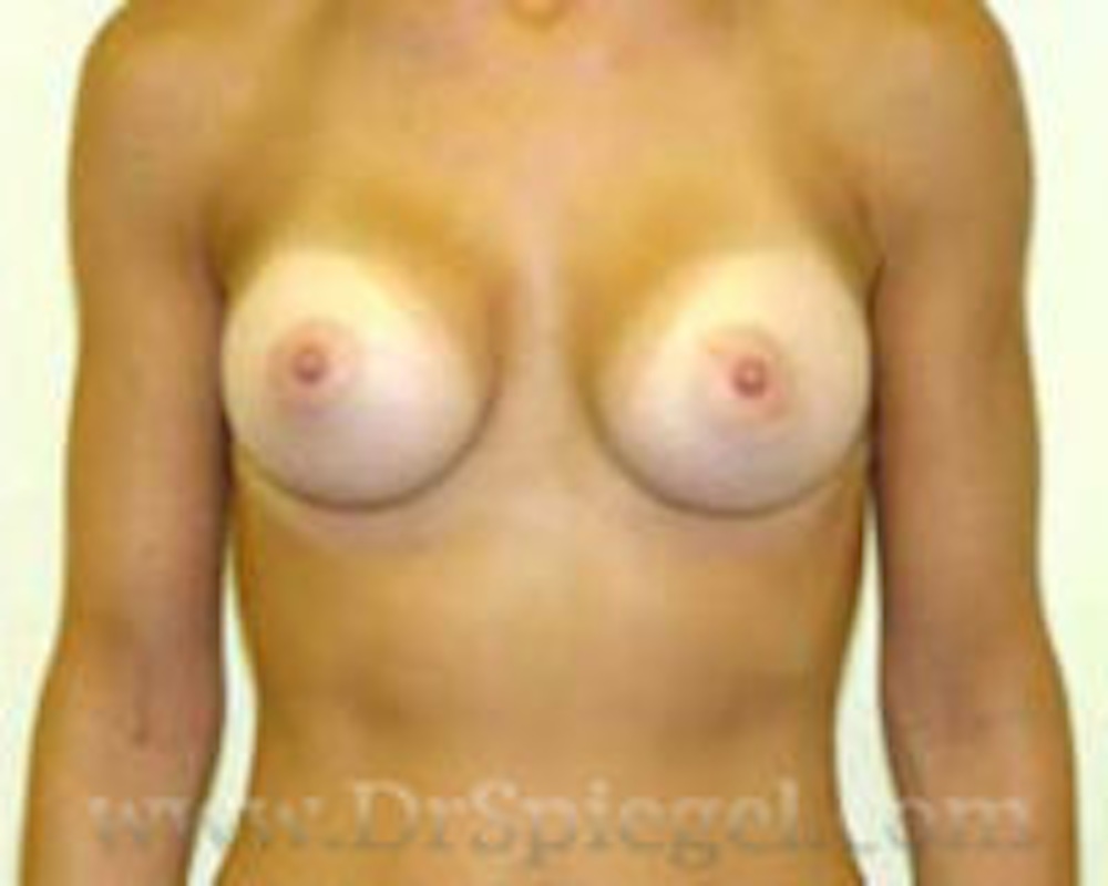 Breast Augmentation
