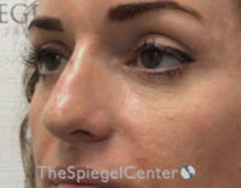 Non-Surgical Rhinoplasty / Nose Filler Before & After Gallery - Patient 157140672 - Image 4