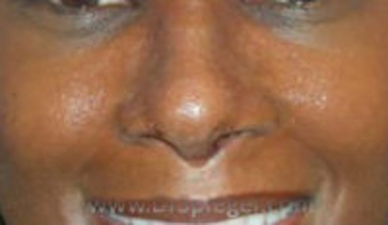 Rhinoplasty Before & After Gallery - Patient 157140671 - Image 2