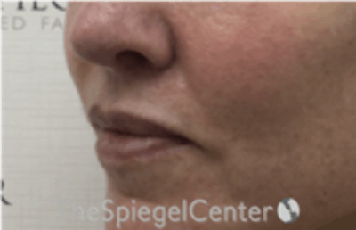 Lip Lift Before & After Gallery - Patient 261335 - Image 3