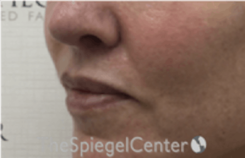Lip Filler Before & After Gallery - Patient 157140676 - Image 3