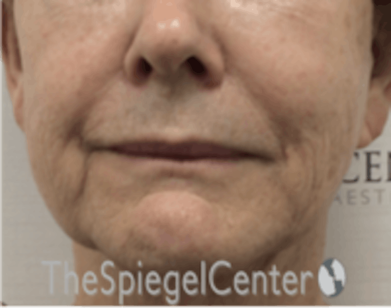 Nasolabial Fold Filler Before & After Gallery - Patient 157140683 - Image 1