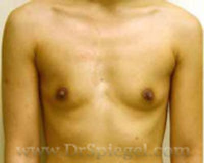 Breast Augmentation Before & After Gallery - Patient 157140677 - Image 1