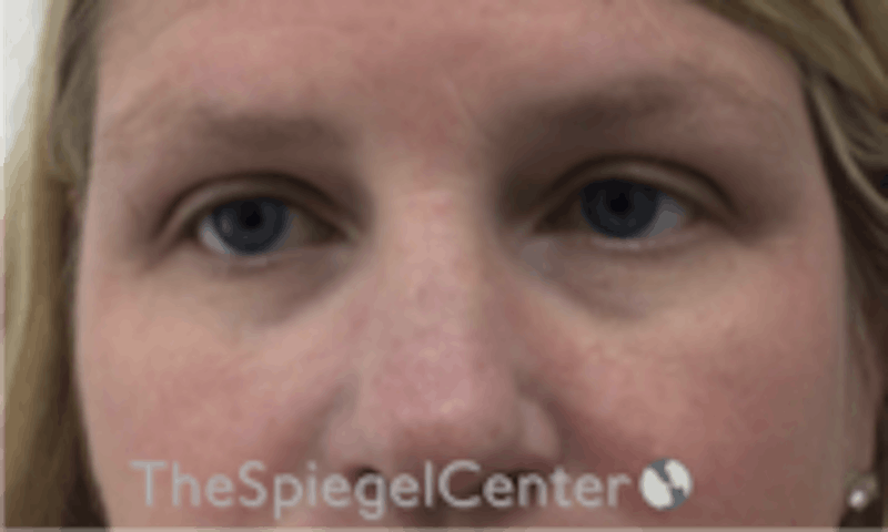 Tear Trough / Under Eye Fillers Before & After Gallery - Patient 157140684 - Image 1