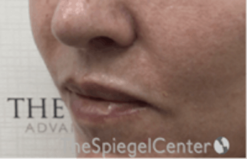 Lip Lift Before & After Gallery - Patient 261335 - Image 4