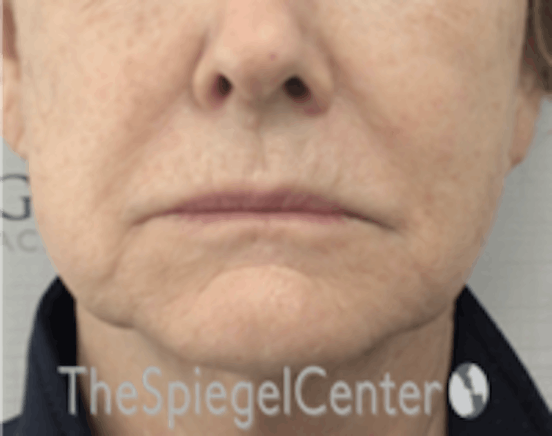 Nasolabial Fold Filler Before & After Gallery - Patient 157140683 - Image 2
