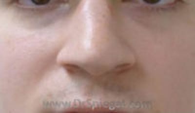 Rhinoplasty Before & After Gallery - Patient 157140680 - Image 1