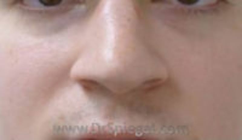 Rhinoplasty Before & After Gallery - Patient 157140680 - Image 1