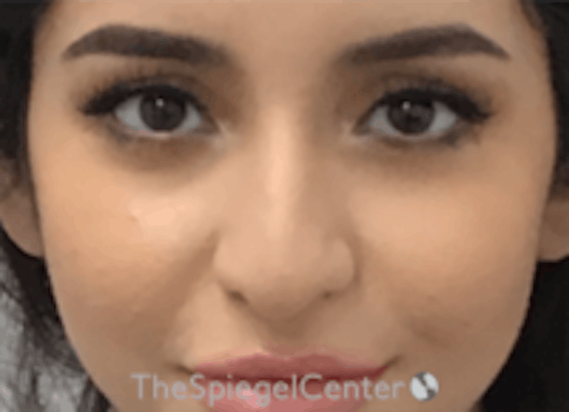 Non-Surgical Rhinoplasty / Nose Filler Before & After Gallery - Patient 157140687 - Image 1