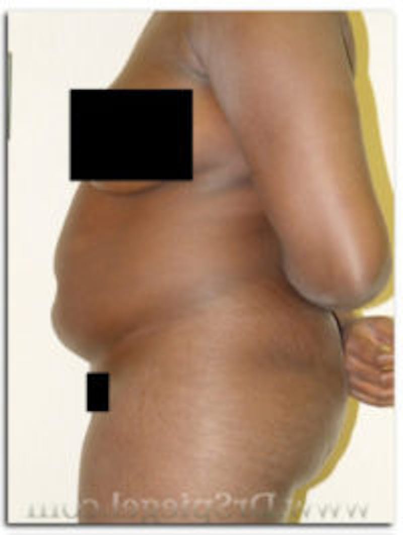 Liposuction Before & After Gallery - Patient 157140681 - Image 1