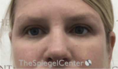 Tear Trough / Under Eye Fillers Before & After Gallery - Patient 677561 - Image 2