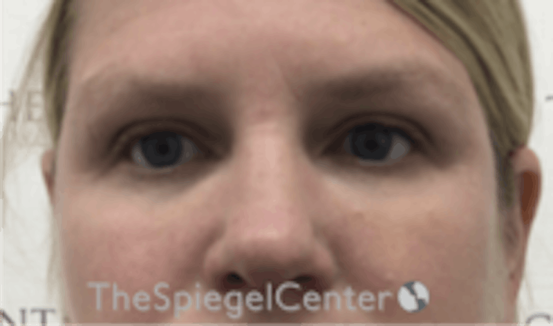 Tear Trough / Under Eye Fillers Before & After Gallery - Patient 677561 - Image 2