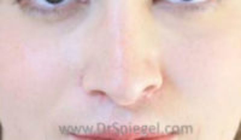 Rhinoplasty Before & After Gallery - Patient 157140680 - Image 2