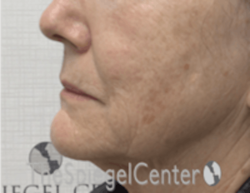 Nasolabial Fold Filler Before & After Gallery - Patient 157140683 - Image 3
