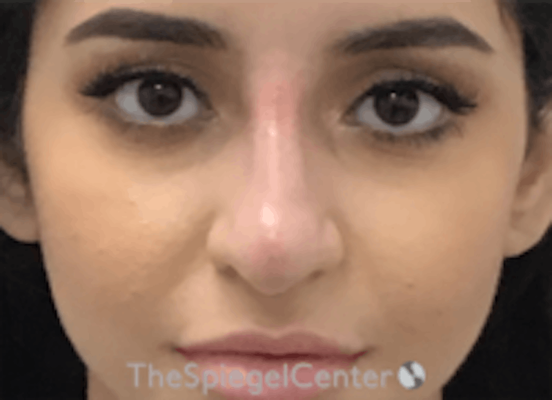 Non-Surgical Rhinoplasty / Nose Filler Before & After Gallery - Patient 157140687 - Image 2